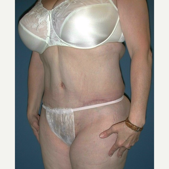 45-54 year old woman treated with Extended Tummy Tuck and Liposuction after 3682410