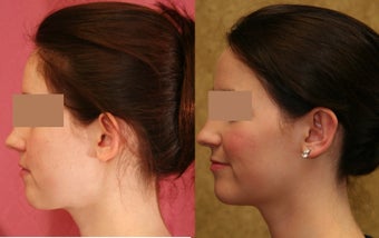 Ear pinning or otoplasty before and after pictures 1010472
