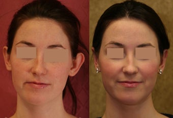 Ear pinning or otoplasty before and after pictures before 1010472