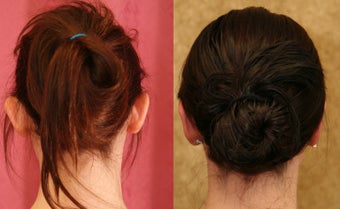 Ear pinning or otoplasty before and after pictures after 1010472