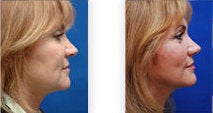 Facelift for jaw and neckline before 88833