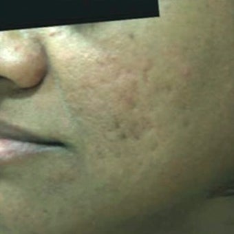 25-34 year old man treated with Derma Roller before 1789336