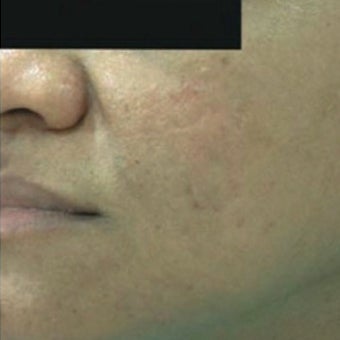25-34 year old man treated with Derma Roller after 1789336