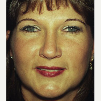 35-44 year old woman treated with Rhinoplasty after 3705145