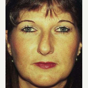 35-44 year old woman treated with Rhinoplasty before 3705145