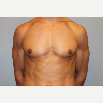 25-34 year old man treated with Male Breast Reduction after 3565057