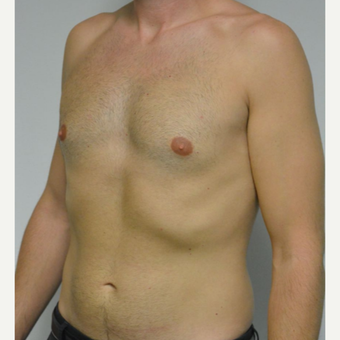 25-34 year old man treated with Male Breast Reduction before 3683760
