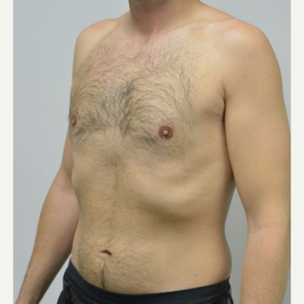 25-34 year old man treated with Male Breast Reduction after 3683760