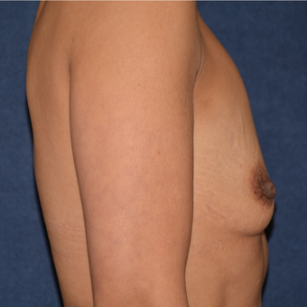 45-54 year old woman treated with Breast Augmentation before 3413172