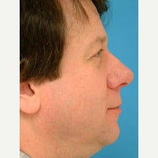 45-54 year old man treated with Rhinoplasty 1847753
