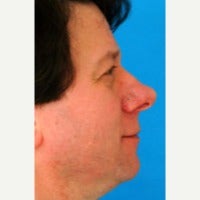 45-54 year old man treated with Rhinoplasty 1847753