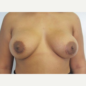 Breast Implant Revision after 3168592