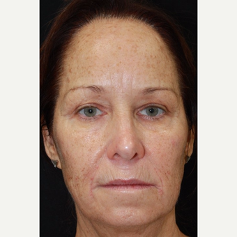56 year old female treated with Voluma to the midface after 2994695