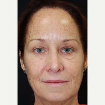 56 year old female treated with Voluma to the midface before 2994695