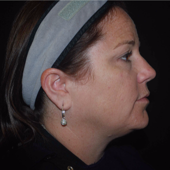 35-44 year old woman treated with Fotona 4D Non Surgical Face Lift before 3506223