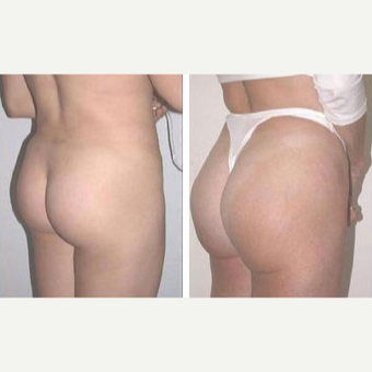 25-34 year old woman treated with Butt Implants before 3659491