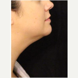 25-34 year old woman treated with truSculpt after 3588214