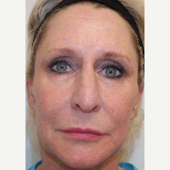 45-54 year old woman treated with Restylane in Tear Troughs, Cheek, Periocular, and PreJowl Sulcus after 3240738