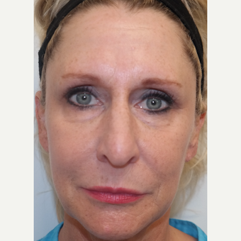45-54 year old woman treated with Restylane in Tear Troughs, Cheek, Periocular, and PreJowl Sulcus before 3240738