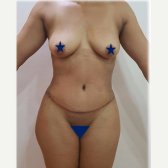 25-34 year old woman treated with Tummy Tuck after 3249260