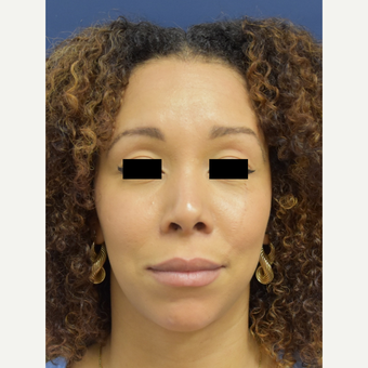 25-34 year old woman treated with Septoplasty after 3496717