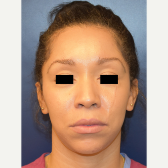25-34 year old woman treated with Septoplasty before 3496717