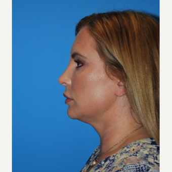 35-44 year old woman treated with Kybella before 2891455