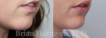 27 year-old female before and 1 week after lip injection with Restylane before 3441387