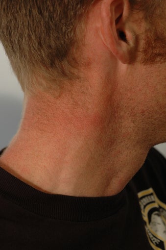 Neck Tattoo Removal -Laser Treatment after 203261