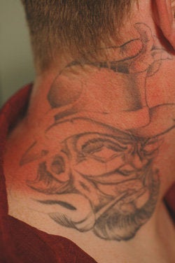 Neck Tattoo Removal -Laser Treatment before 203261