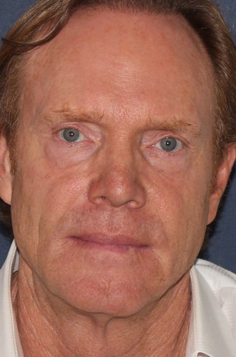 61 year old male treated with fillers after 1060719