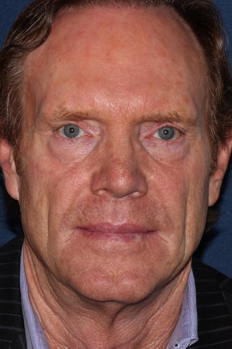 61 year old male treated with fillers before 1060719