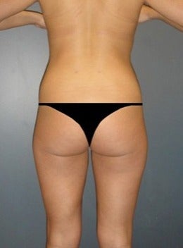 Early 20's Female Liposuction Patient after 1614419