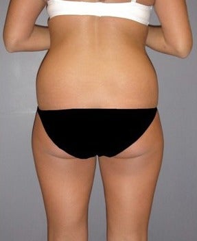 Early 20's Female Liposuction Patient before 1614419