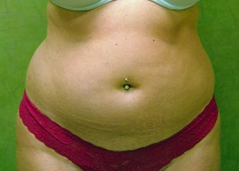 Liposuction Patient before 696115