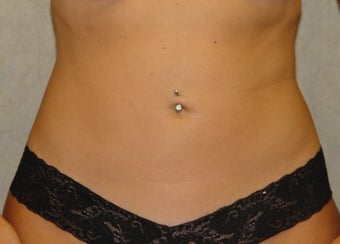 Liposuction Patient after 696115