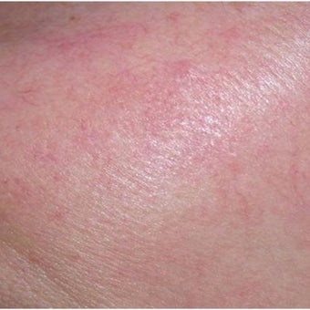 45-54 year old woman treated with IPL after 2543847