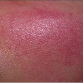 45-54 year old woman treated with IPL before 2543847