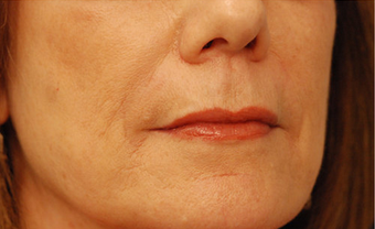 Restylane after 149889