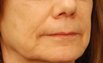 Restylane before 149889