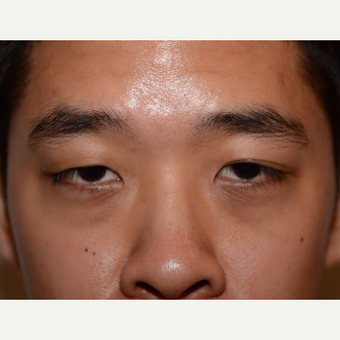 25-34 year old man treated with Asian Eyelid Surgery before 3803212