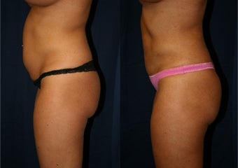 Liposuction after 997124