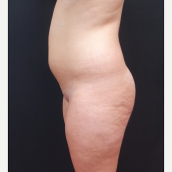18-24 year old woman treated with Butt Lift before 3315520