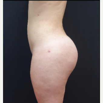 18-24 year old woman treated with Butt Lift after 3315520