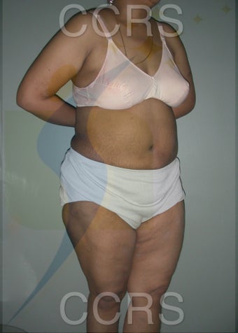41 yr. old female. Tummy Tuck with VASER lipo for body contouring 1042666