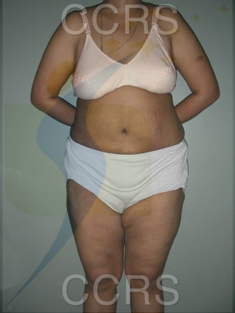 41 yr. old female. Tummy Tuck with VASER lipo for body contouring after 1042666