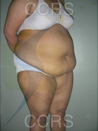 41 yr. old female. Tummy Tuck with VASER lipo for body contouring 1042666