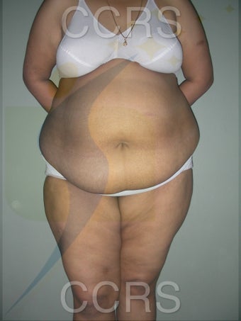 41 yr. old female. Tummy Tuck with VASER lipo for body contouring before 1042666