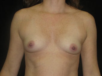 Natural Fill Breast Augmentation before 487258