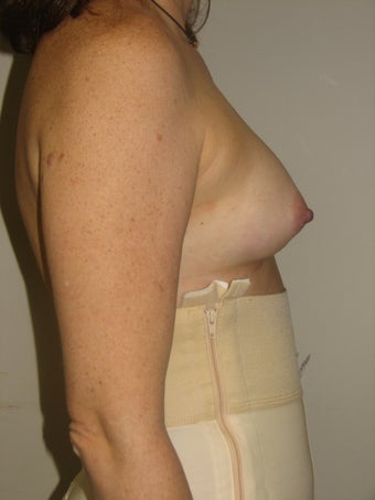 Natural Fill Breast Augmentation 487258